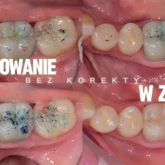Jak stosować cement NoMIX, aby uniknąć nieprzyjemnych sytuacji z koronami dentystycznymi