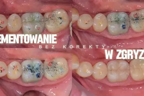 Jak stosować cement NoMIX, aby uniknąć nieprzyjemnych sytuacji z koronami dentystycznymi